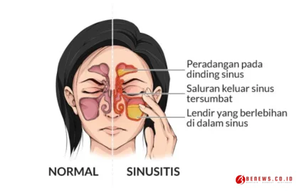 gejala gangguan sinus