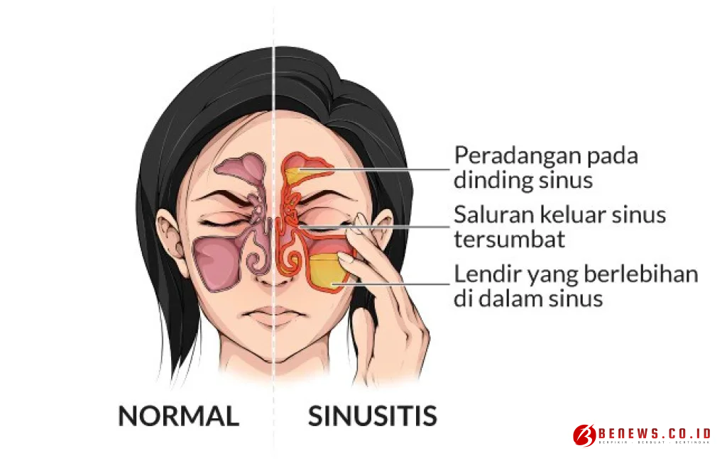 gejala gangguan sinus